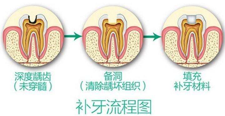 牙齿上的小黑点，你真的会用吗？