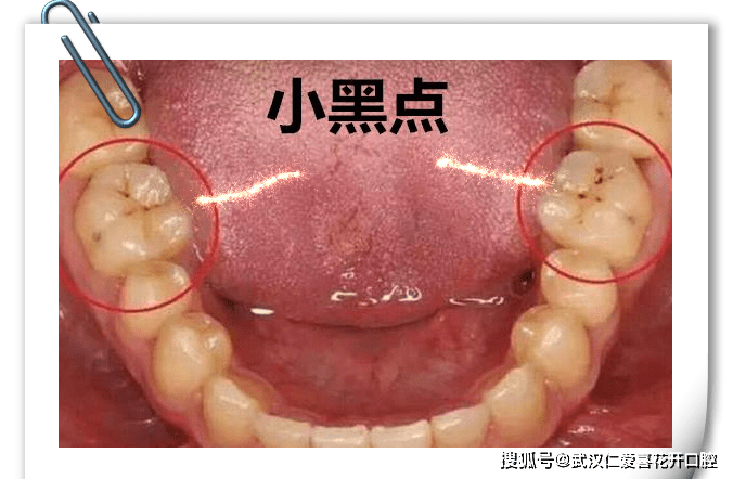 牙齿上的小黑点，你真的会用吗？