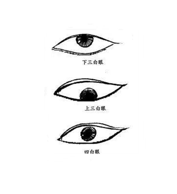 （李向东）眼睛最多见的眼睛就是四白眼