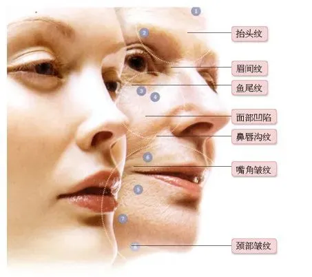 印堂川字纹是面部皱纹中一种常见的表情纹